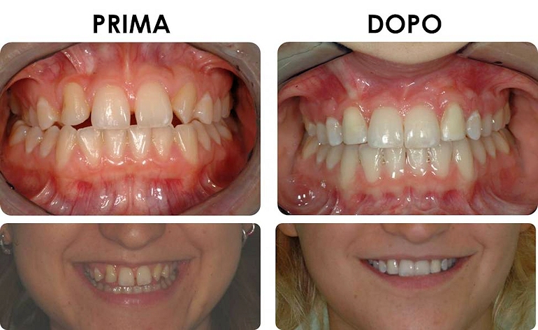 studio picchioni odontoiatria agenesia incisivi laterali
