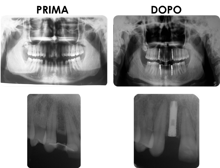 studio picchioni odontoiatria impianti denti