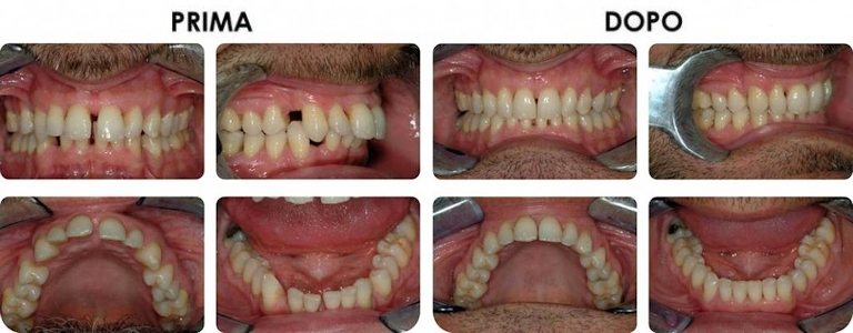studio picchioni odontoiatria ortodonzia invisibile