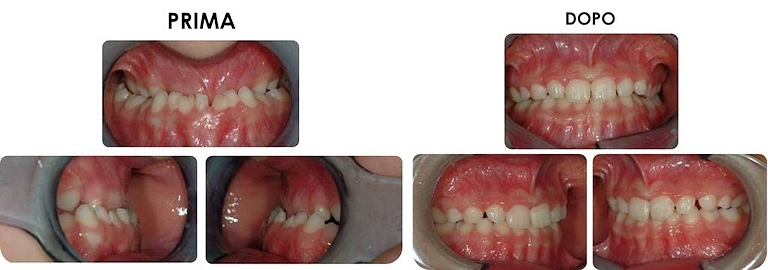 studio picchioni odontoiatria ortodonzia morso inverso