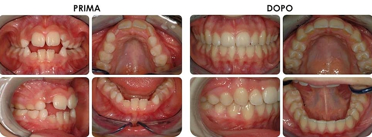 studio picchioni odontoiatria ortodonzia prima e dopo
