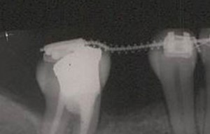 endodonto terapia