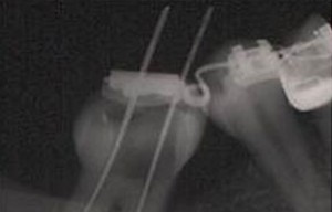 endodonzia