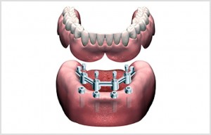 impianti protesi overdenture