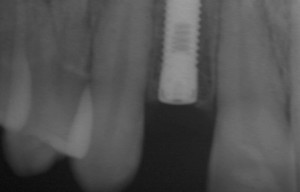 impiantologia dente singolo