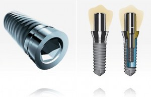 impiantologia denti