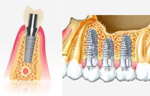 impiantologia denti esempio
