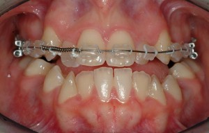 ortodonzia prechirurgica applicazione