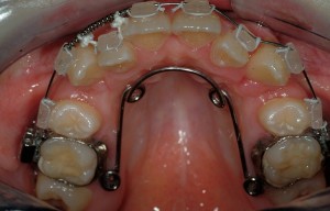 ortodonzia prechirurgica esempio applicazione