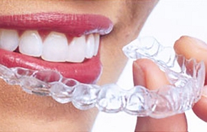tecnica invisalign